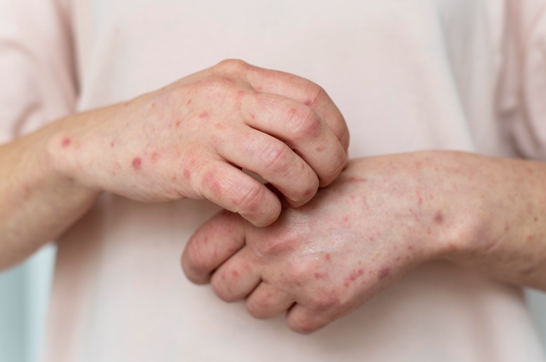 The Most Common Skin Infections: What You Should Know